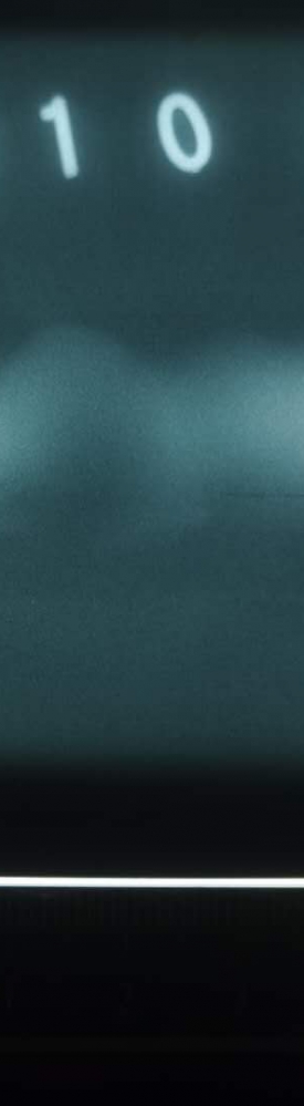 請(qǐng)大家看看這是未熔合還是裂紋